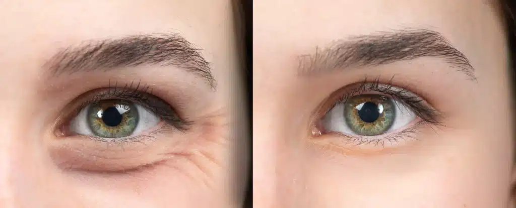 Zbliżenie na okolice oczu z kurzymi łapkami - po lewej kurze łapki, po prawej po kuracji przeciwzmarszczkowej