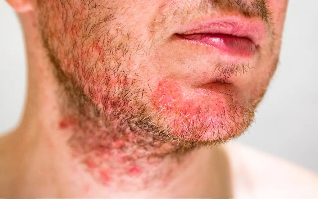 Zbliżenie na męską twarz z zarostem i czerwonymi plamami