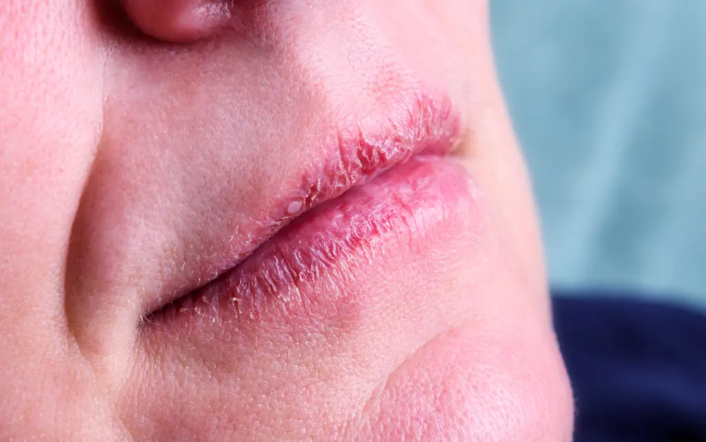 Suche, spierzchnięte usta