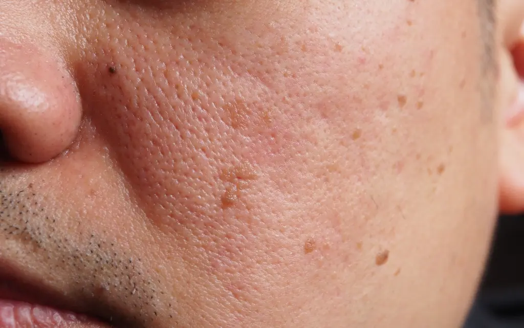 Przebarwienia na męskiej twarzy, zbliżenie na plamy