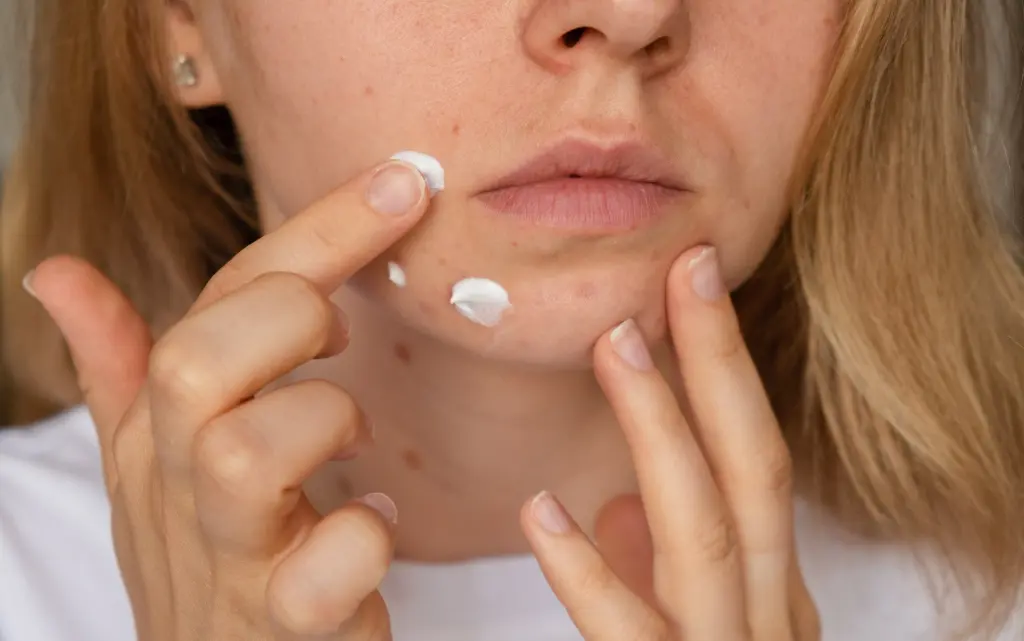 Młoda kobieta nakłada punktowo krem na zaskórniki