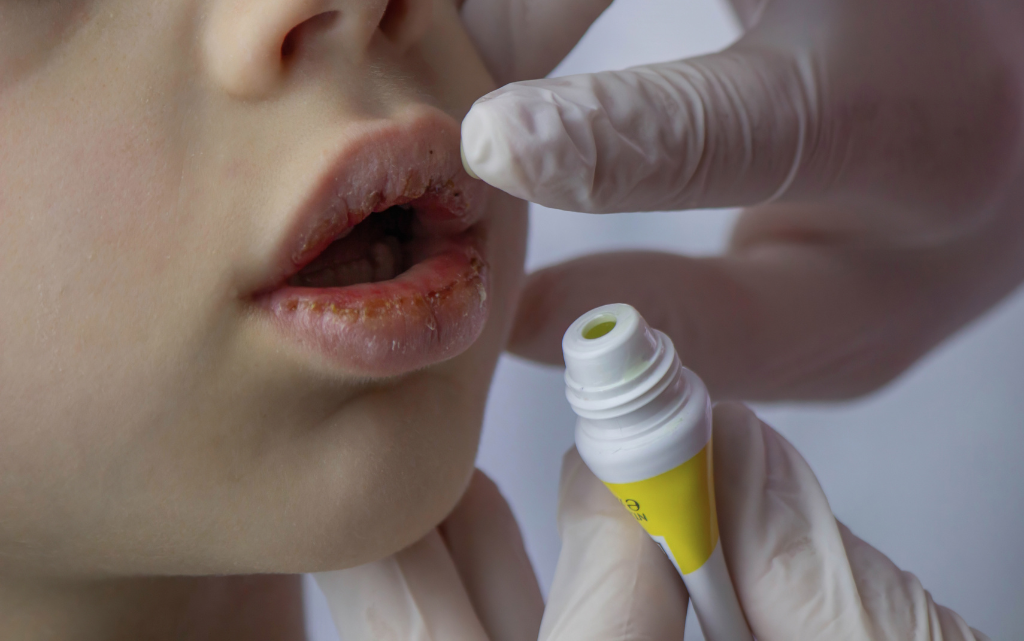 Nakładanie wazeliny kosmetycznej na spierzchnięte usta dziecka