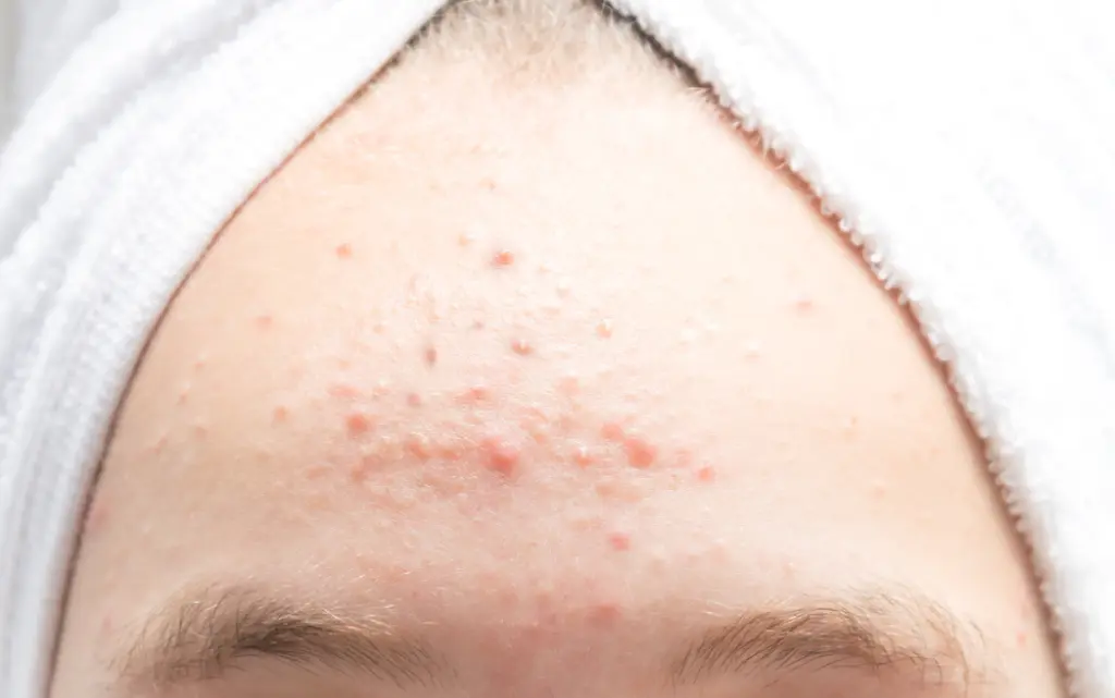 Kobiece czoło pokryte licznymi grudkami i zmianami skórnymi