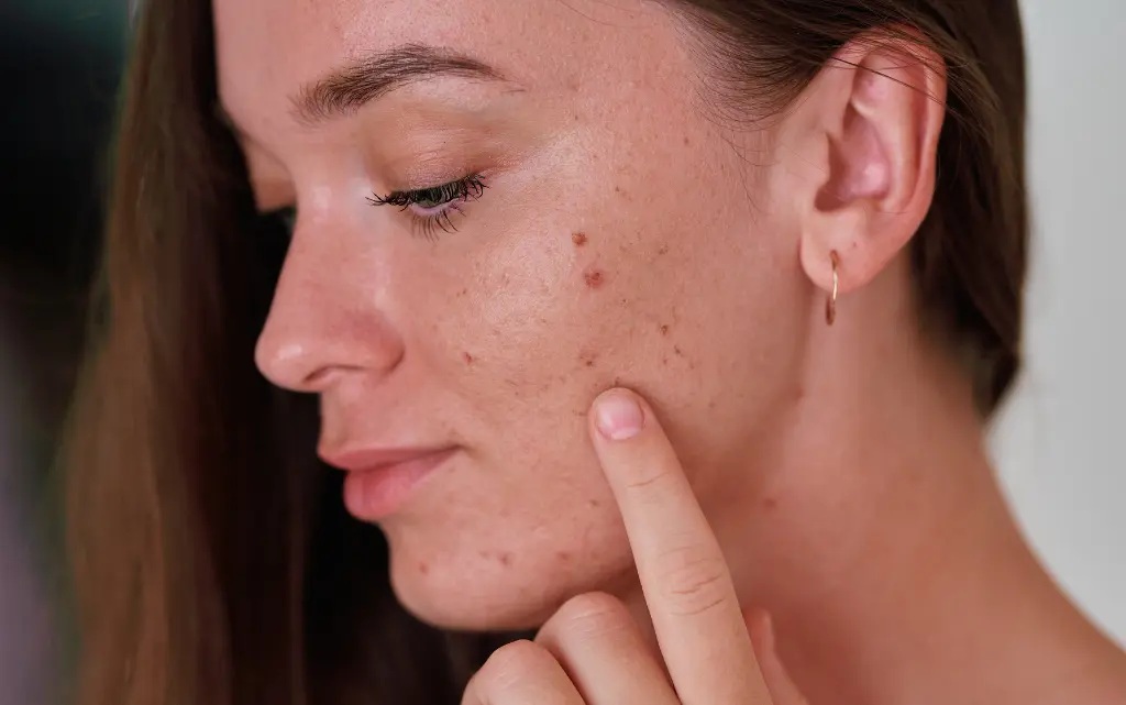 Twarz młodej kobiety pokazującej palcem blizny po trądziku