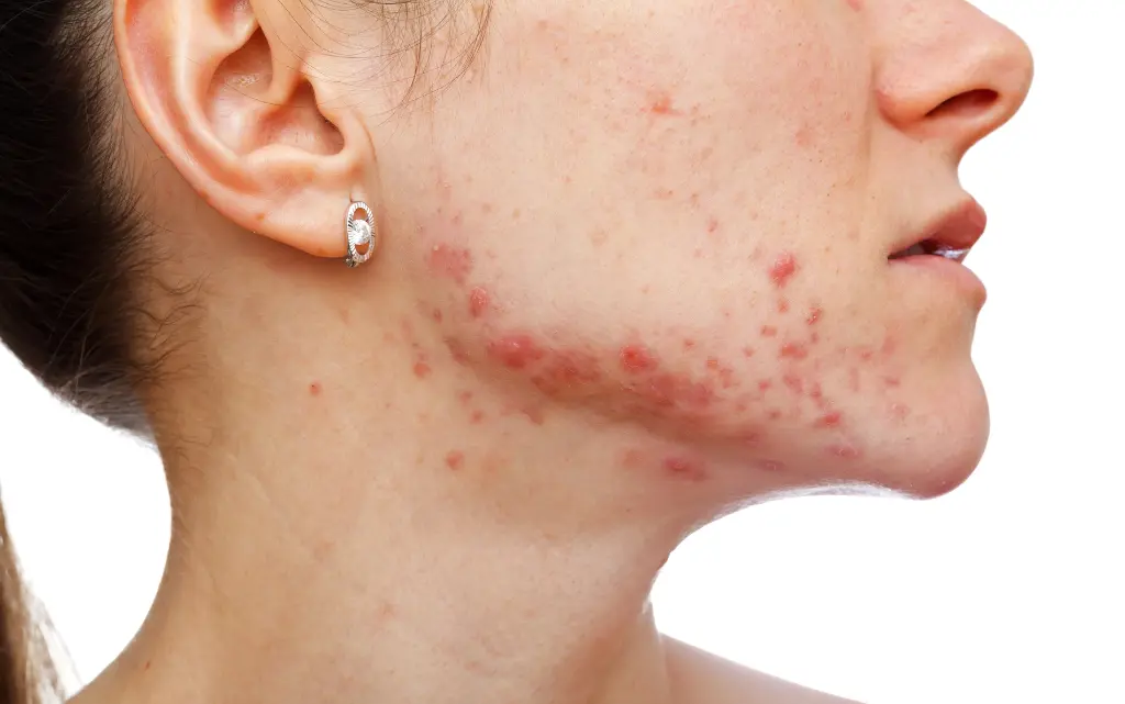Boczny profil kobiecej twarzy ze zmianami na cerze trądzikowej
