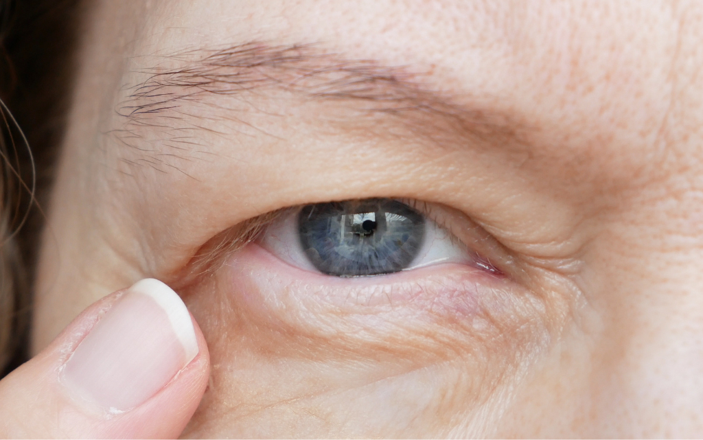 Kobieta pokazuje opadającą powiekę bez makijażu