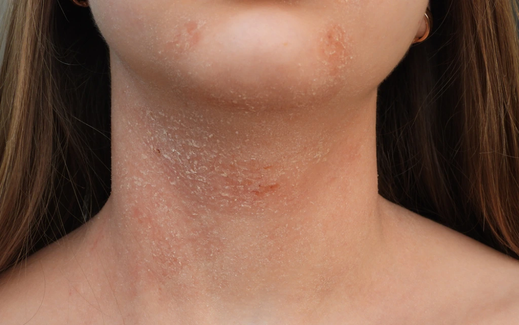 Młoda dziewczyna pokazuje szyję z atopowym zapaleniem skóry