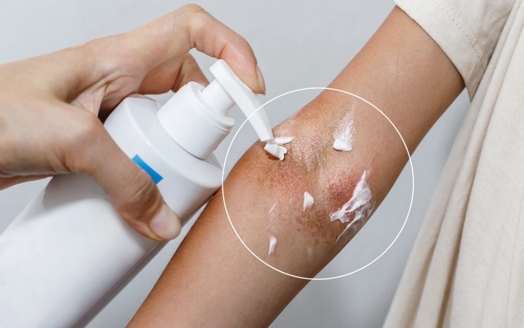 Kobieta nakłada córce krem na atopowe zapalenie skóry w okolicy łokcia