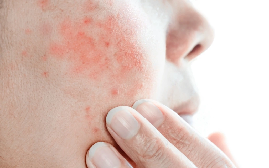 Zaczerwieniony i podrażniony policzek na twarzy z atopowym zapaleniem skóry