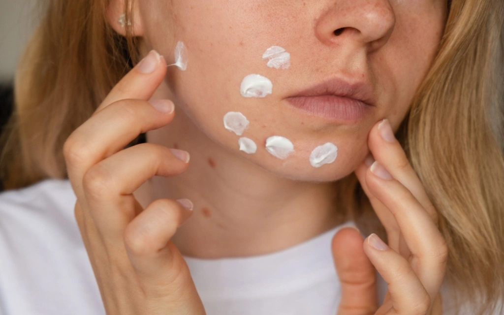 Kobieta nakłada krem na blizny po trądziku