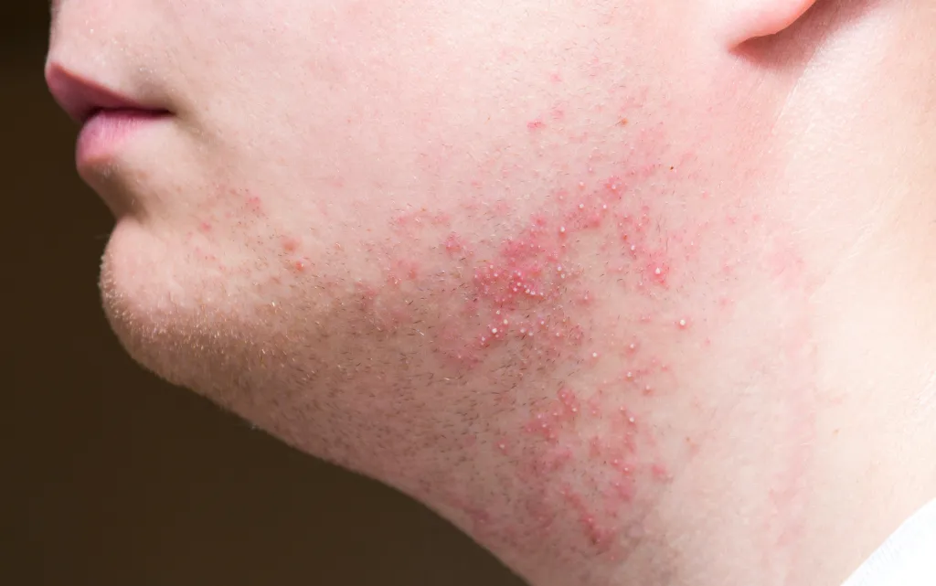 Profil boczny mężczyzny z białymi pryszczami po goleniu