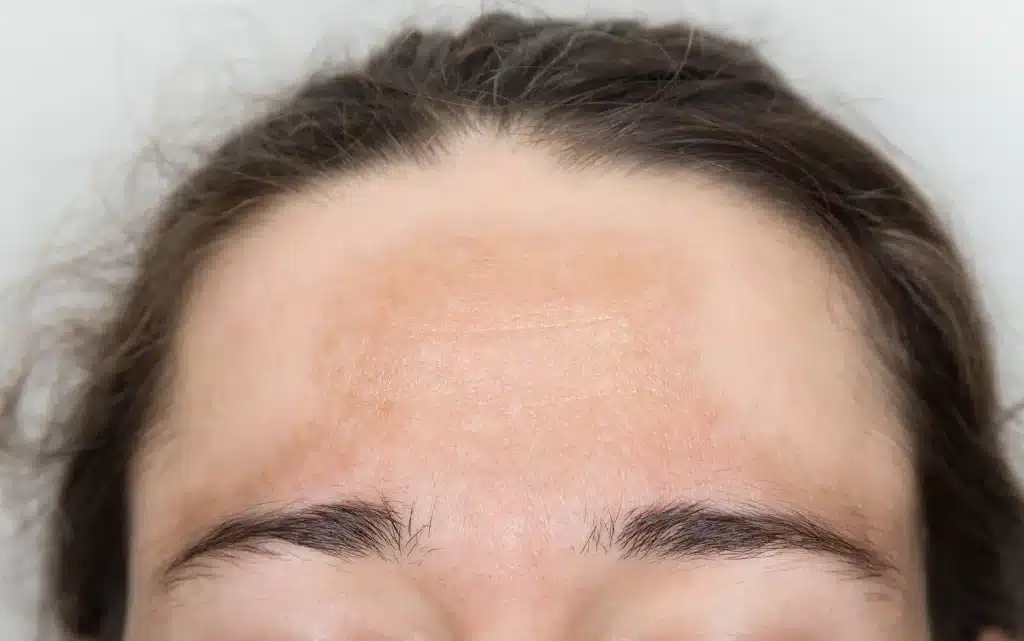 Hiperpigmentacja na czole