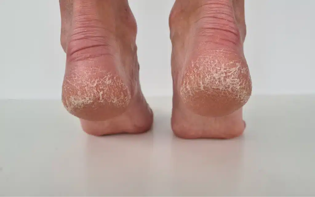 Zrogowaciała skóra na piętach
