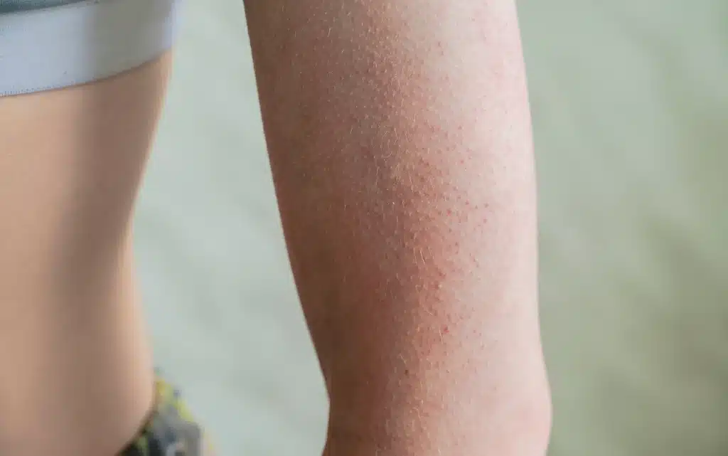 Rogowacenie okołomieszkowe na ramieniu