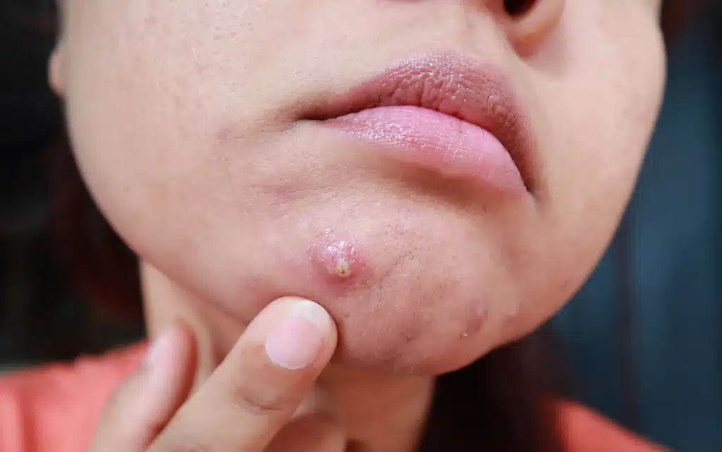 Ropny bolesny pryszcz na brodzie u kobiety