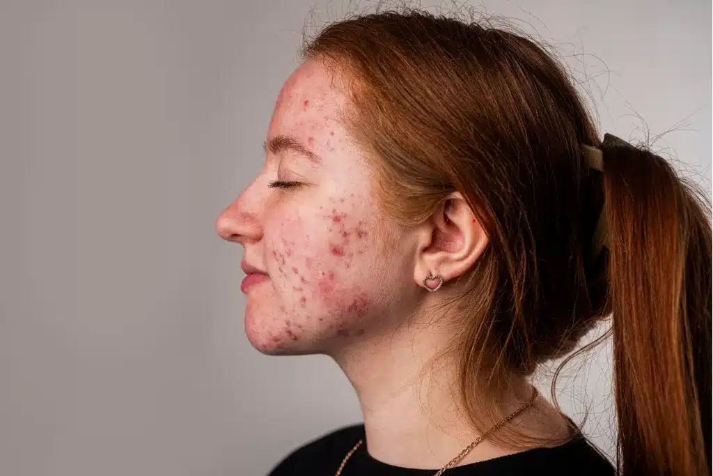 Młoda dziewczyna z trądzikiem