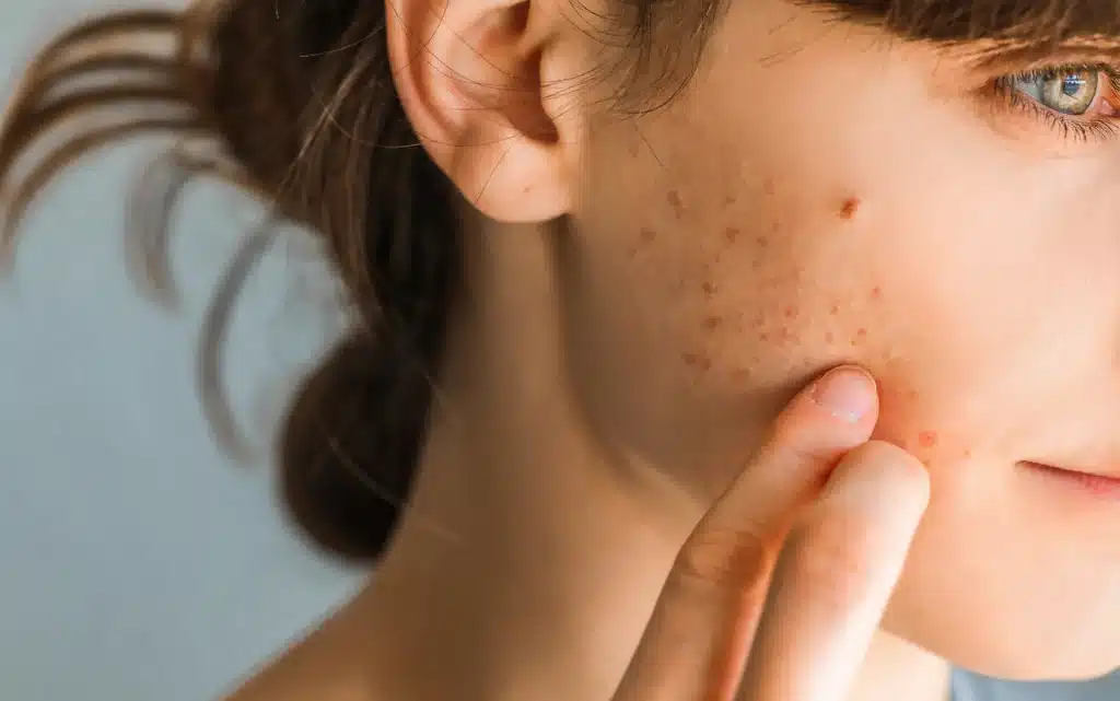 Krosty na twarzy u kobiet najczęściej mają podłoże hormonalne