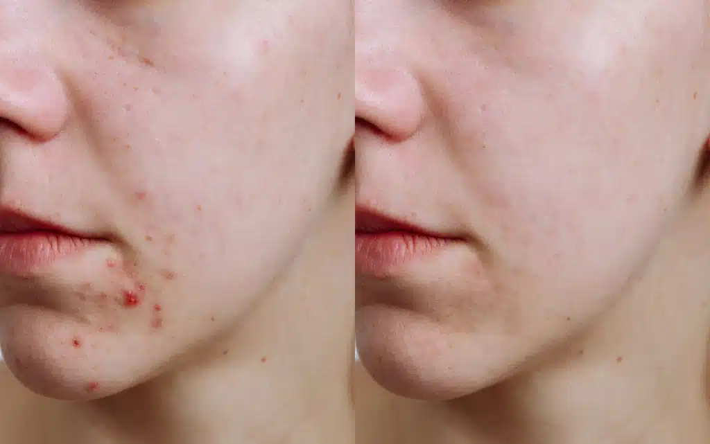 Leczenie wyprysków: przed i po