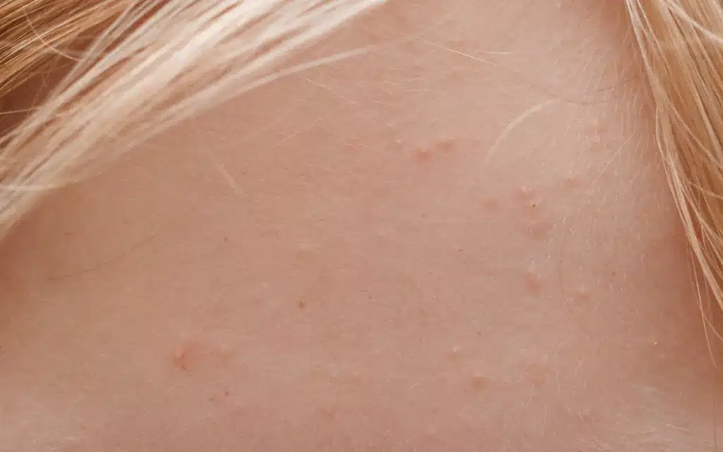 Czoło z widoczną kaszką