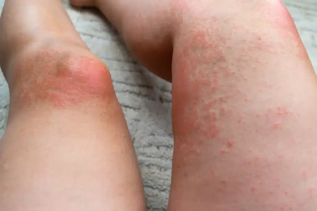 Alergia na słońce na nogach