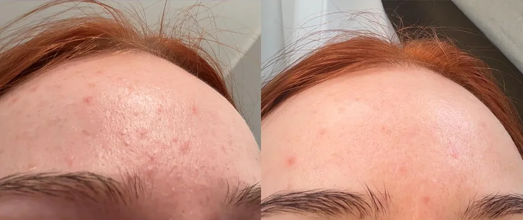 Efekty przed i po stosowaniu Skinimal Intensywne serum przeciwstarzeniowe retinol 2% i skwalan
